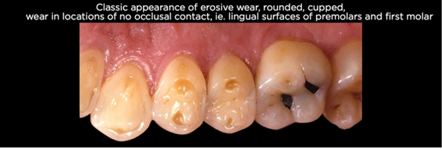 Tooth Erosion Treatment Alexandria, VA | Kenneth M. Van Stralen, DDS